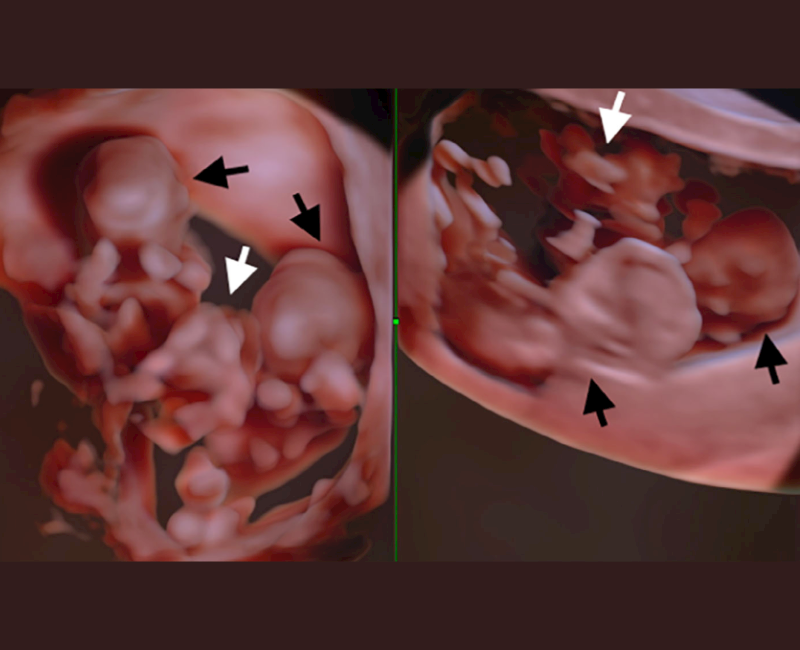 Early prenatal diagnosis of acardiac anomaly: A triplet case report